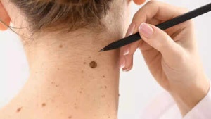 6 Subtle Signs of Melanoma You Might Be Missing