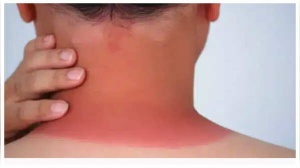 Skin Cancer: Don't Ignore These 5 Early Warning Signs