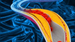 How to reverse plaque to prevent a heart attack, according to a US doctor