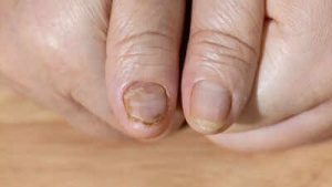 Fragile Nails: A Warning Sign? Potential Health Issues and How to Strengthen Them