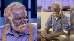 Skin Turning Blue? Understanding Argyria, or 'Smurf Syndrome': Causes, Symptoms, and Prevention