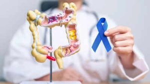 Colorectal Cancer: Top Surgeon Reveals 5 Life-Saving Insights on Symptoms, Risks, and Early Detection