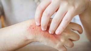 Diabetes and Your Skin: A Guide to 10 Common Problems & How to Manage Them