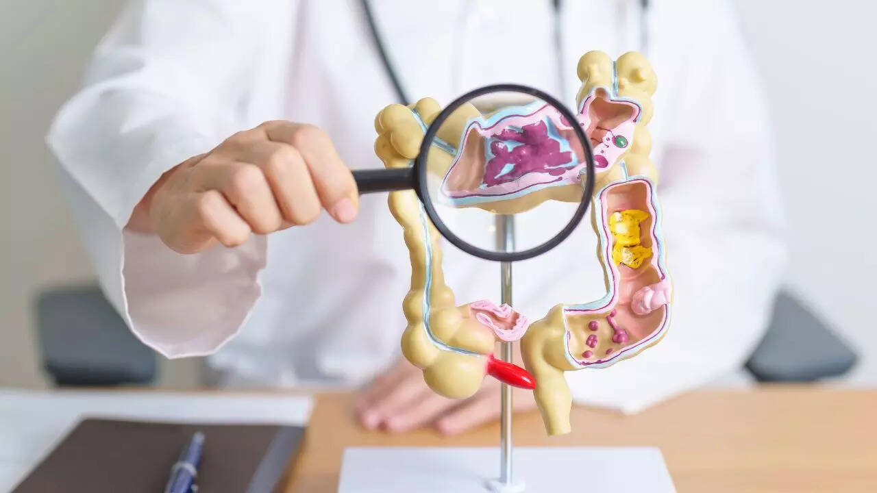 colon cancer risk