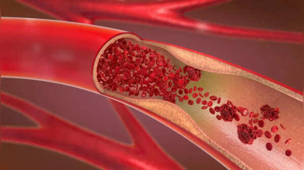 Doctor advises attention to the arteries