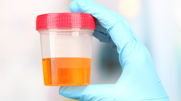 Dark coloured urine